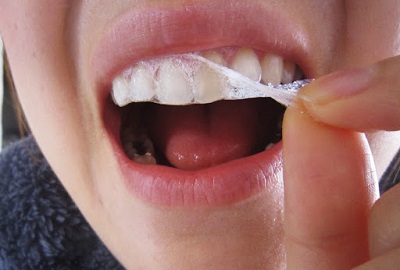 miếng dán trắng răng