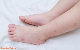 Top 6 thuốc trị sẹo thâm ở chân tốt và được tin dùng nhất