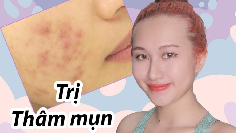 [Review] Kem Trị Thâm Mụn Hiruscar Post Acne có tốt không? Giá Bao Nhiêu?